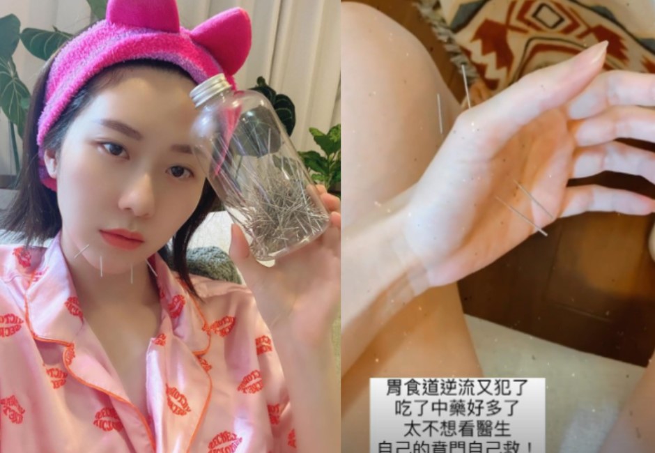 針灸自救!張景嵐胃疾復發不敢出門 自己在家扎14針緩解症狀