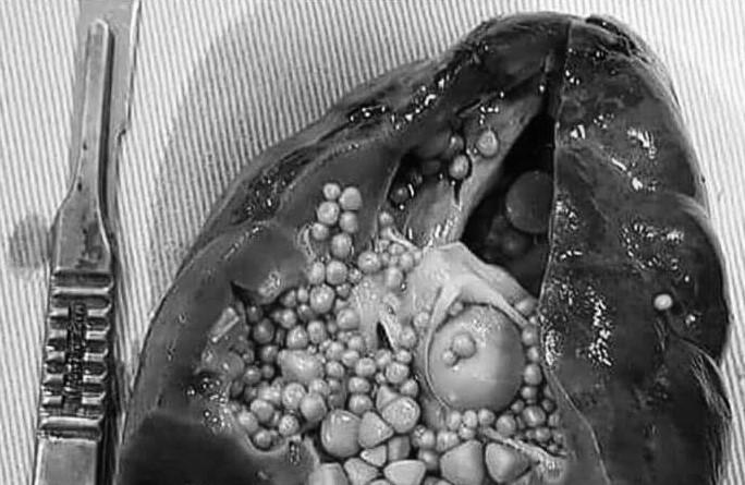 佈滿詭異球狀物…腎結石照片網路瘋傳 醫生驚呼：這顆不行了