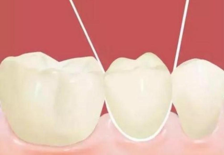 牙線清牙真有用？醫曝關鍵：多數人用錯反而引發牙周病！