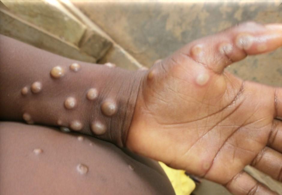 第2例猴痘侵台！猴痘已63國通報 WHO評估是否為公衛緊急事件